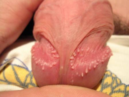 Wicked reccomend pearly penile papules giant clit