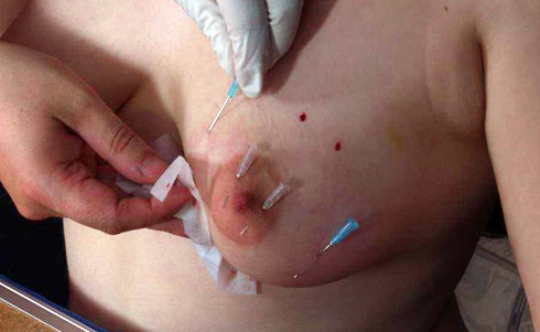 Navel torture with needle