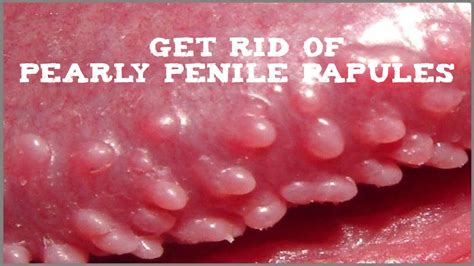 best of Papules remove pearly hirsuties penile free