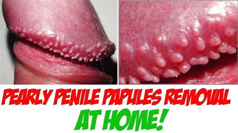 best of Papules remove pearly hirsuties penile free